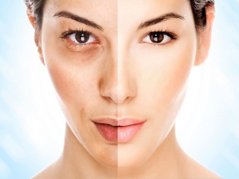 Melasma tem cura?