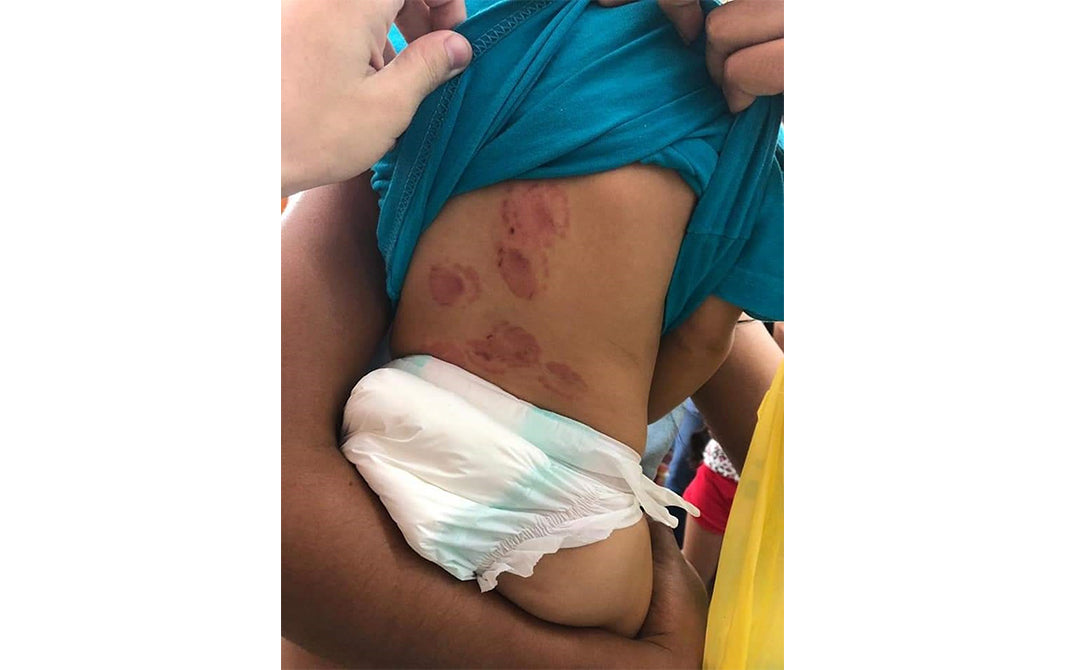 Mãe registra ocorrência após bebê voltar com mordidas da creche